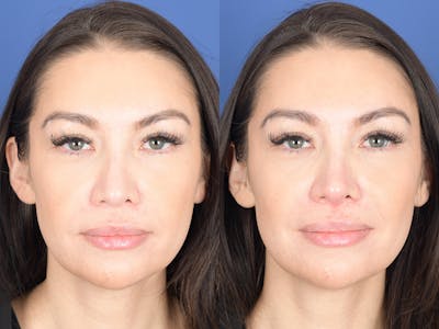 Dermal Filler Before & After Gallery - Patient 403117 - Image 1