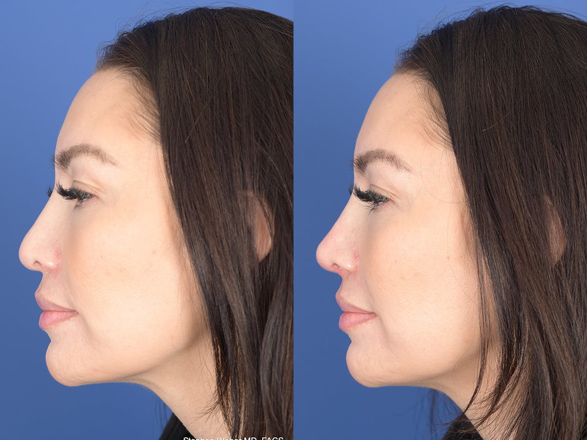 Dermal Filler Before & After Gallery - Patient 403117 - Image 2