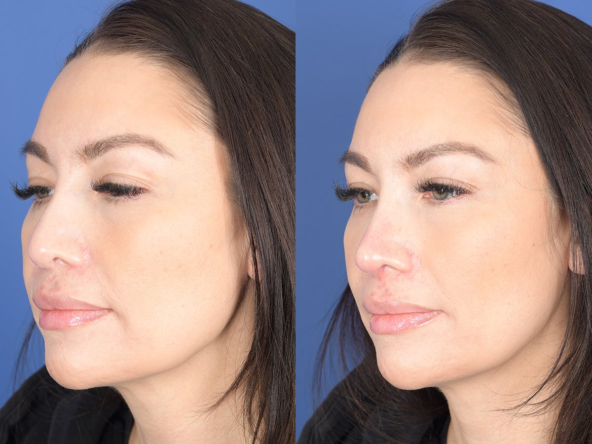 Dermal Filler Before & After Gallery - Patient 403117 - Image 3
