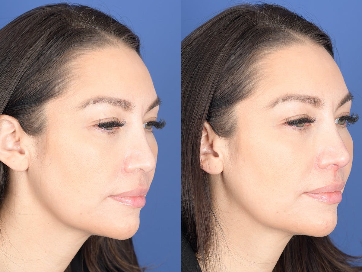 Dermal Filler Before & After Gallery - Patient 403117 - Image 4