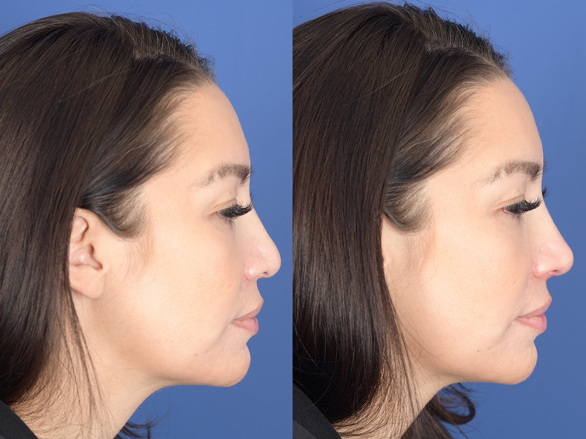 Dermal Filler Before & After Gallery - Patient 403117 - Image 5
