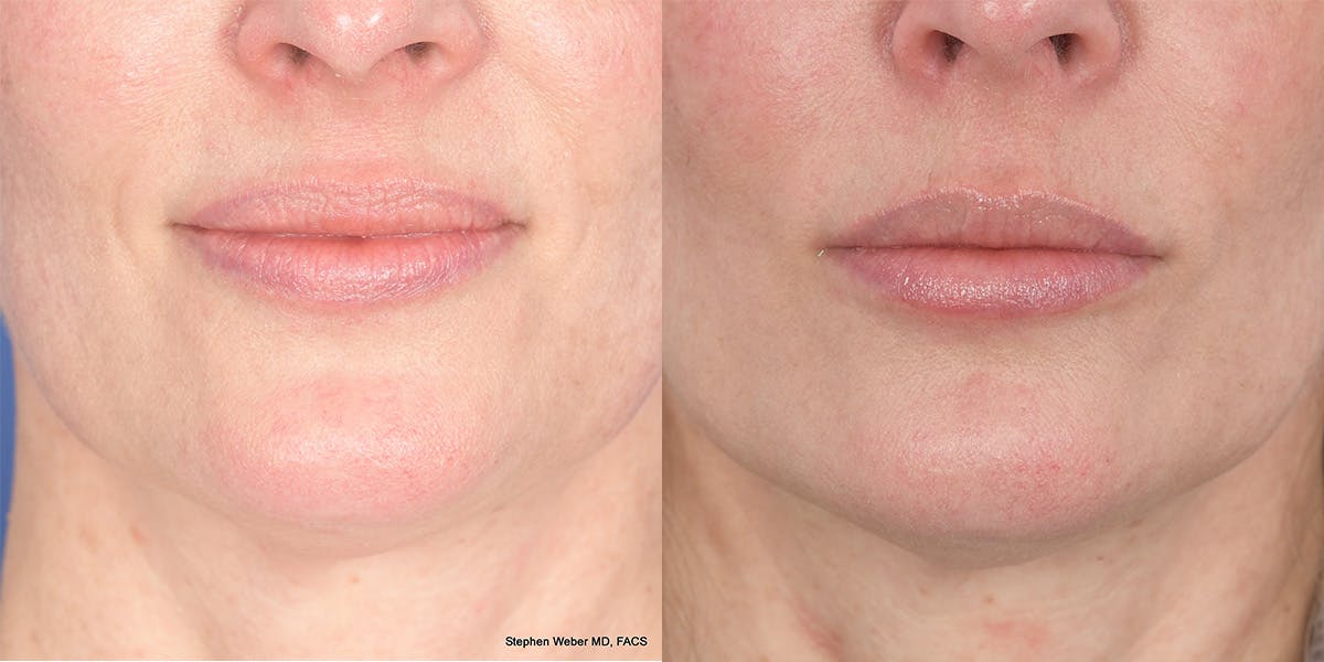 Dermal Filler Before & After Gallery - Patient 414671 - Image 1