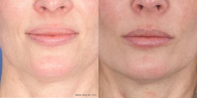 Dermal Filler Before & After Gallery - Patient 414671 - Image 1
