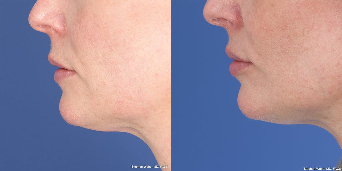 Dermal Filler Before & After Gallery - Patient 414671 - Image 2