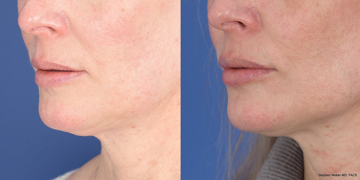 Dermal Filler Before & After Gallery - Patient 414671 - Image 3
