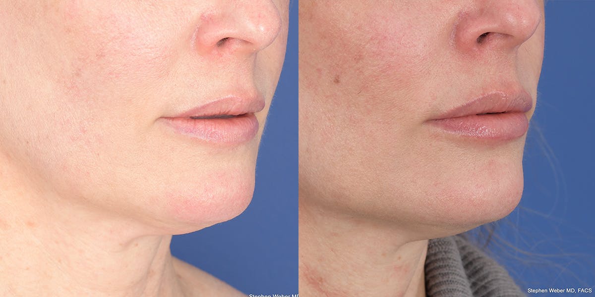 Dermal Filler Before & After Gallery - Patient 414671 - Image 4