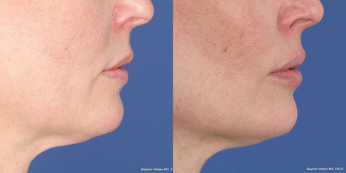 Dermal Filler Before & After Gallery - Patient 414671 - Image 5