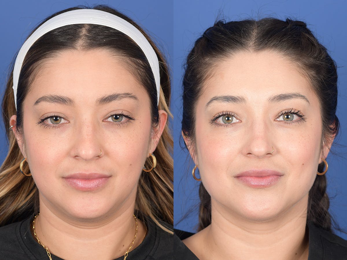 Dermal Filler Before & After Gallery - Patient 219351 - Image 1