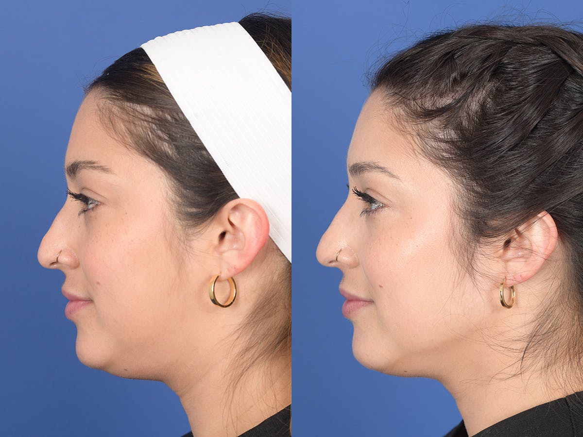 Dermal Filler Before & After Gallery - Patient 219351 - Image 2