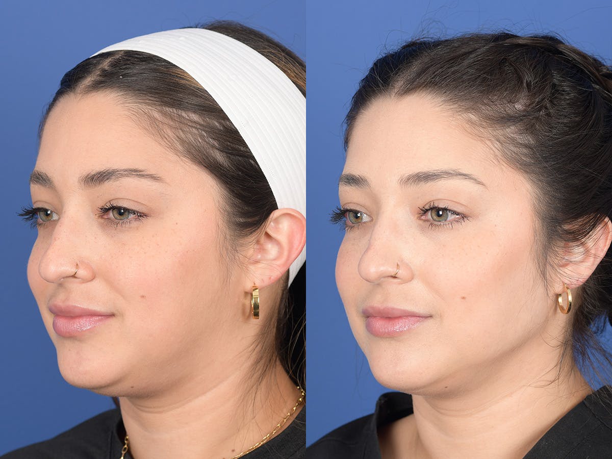 Dermal Filler Before & After Gallery - Patient 219351 - Image 3