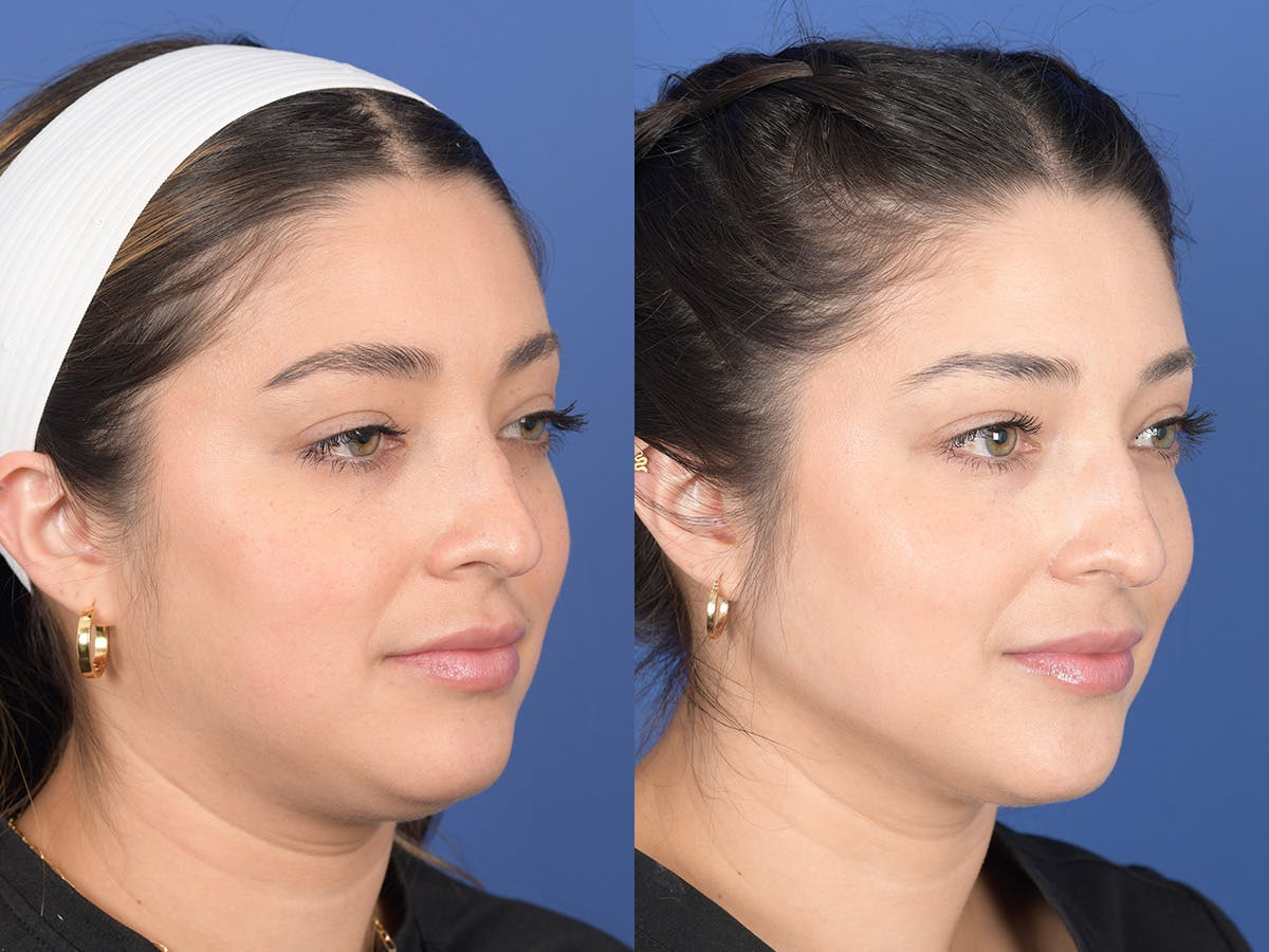 Dermal Filler Before & After Gallery - Patient 219351 - Image 4