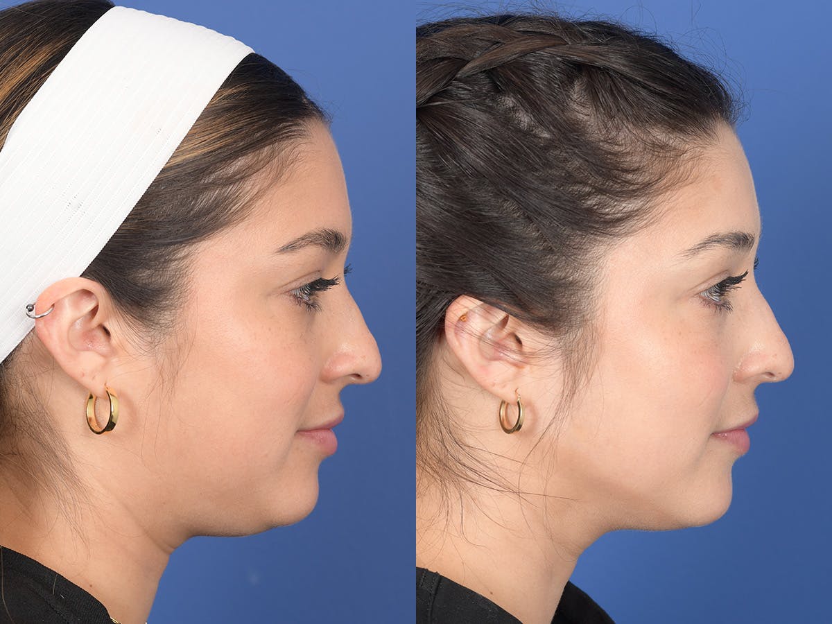 Dermal Filler Before & After Gallery - Patient 219351 - Image 5
