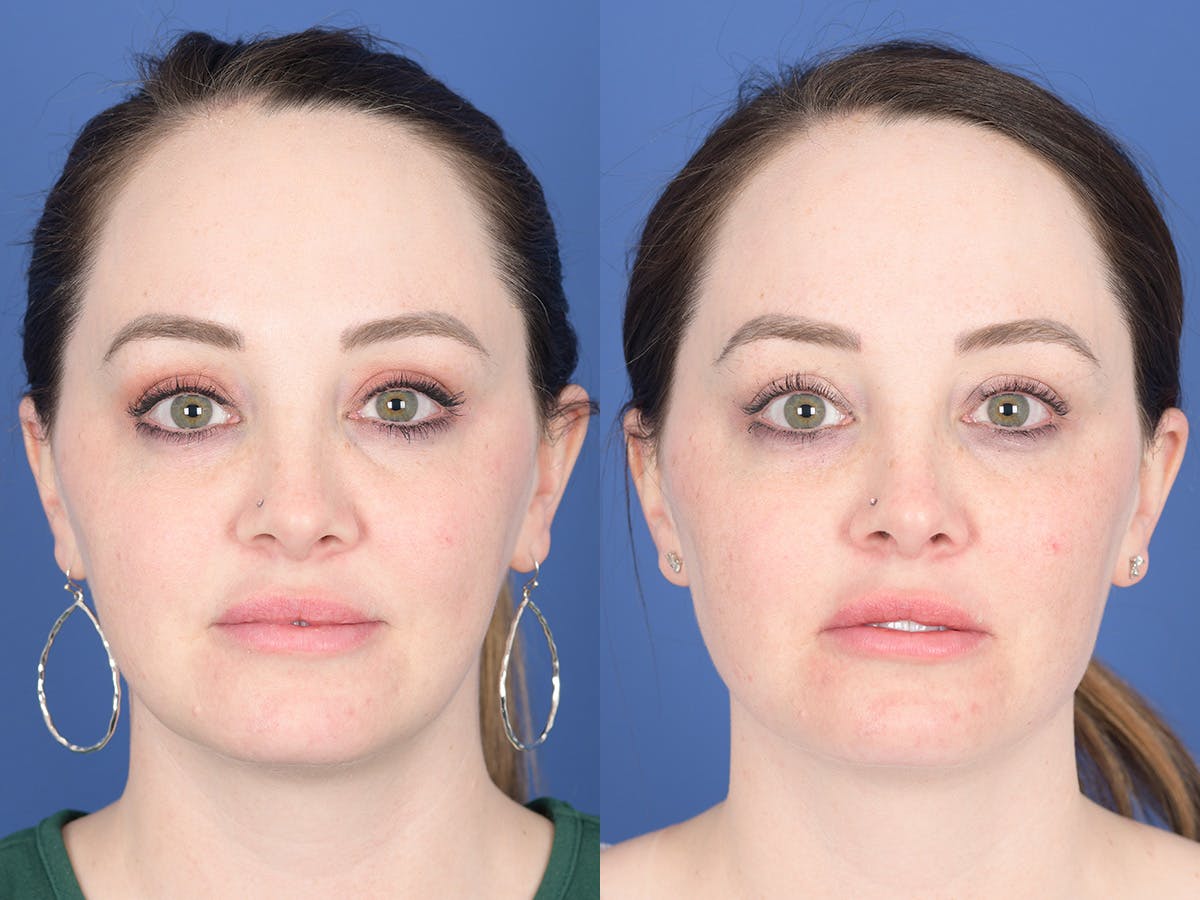 Dermal Filler Before & After Gallery - Patient 154343 - Image 1