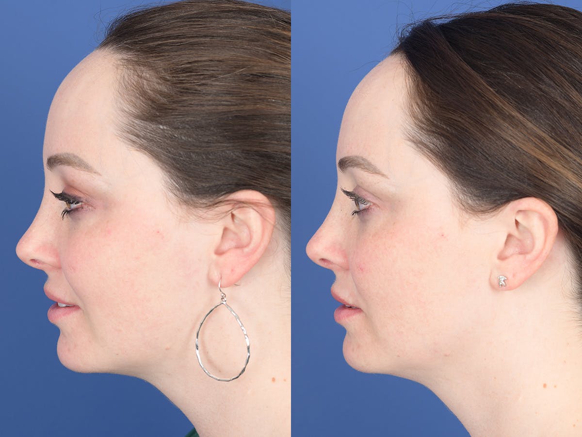 Dermal Filler Before & After Gallery - Patient 154343 - Image 2