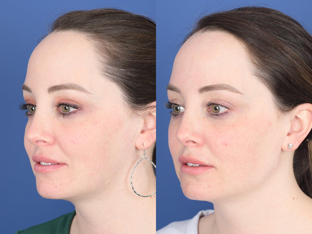 Dermal Filler Before & After Gallery - Patient 154343 - Image 3