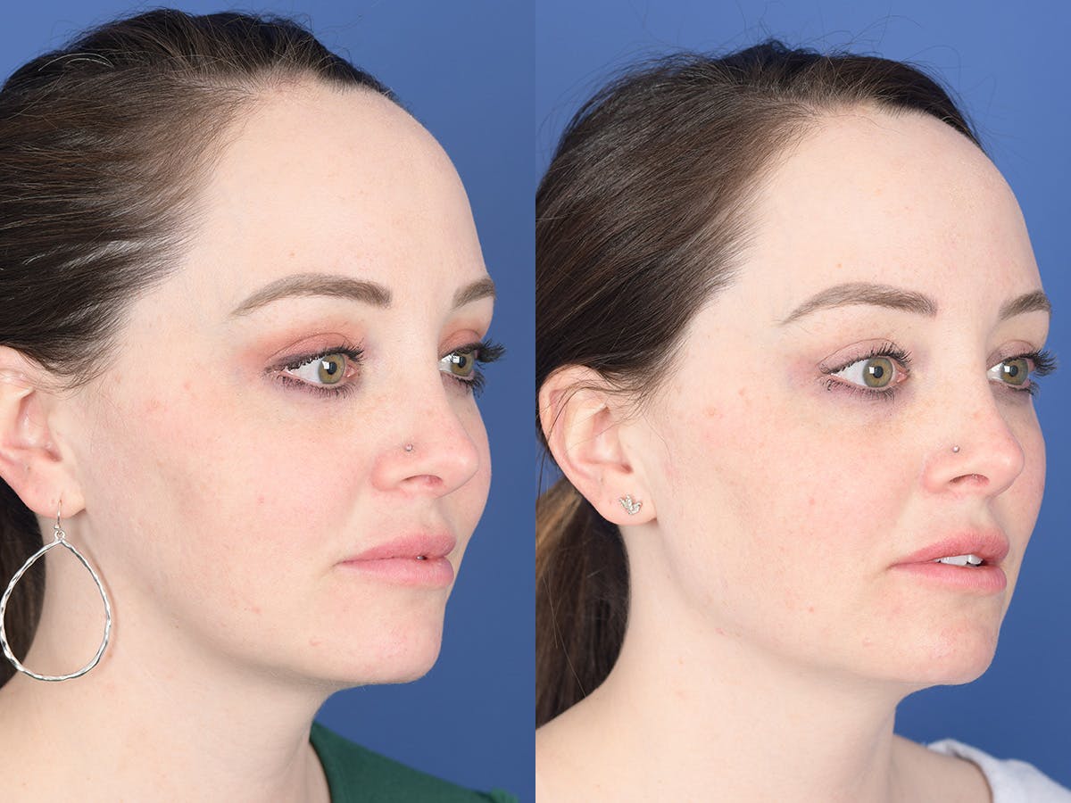 Dermal Filler Before & After Gallery - Patient 154343 - Image 4
