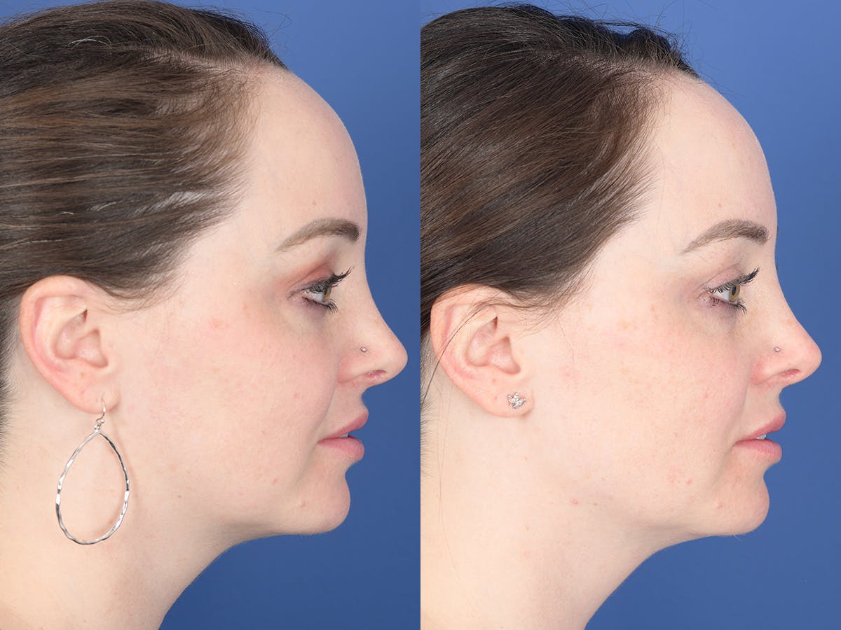 Dermal Filler Before & After Gallery - Patient 154343 - Image 5