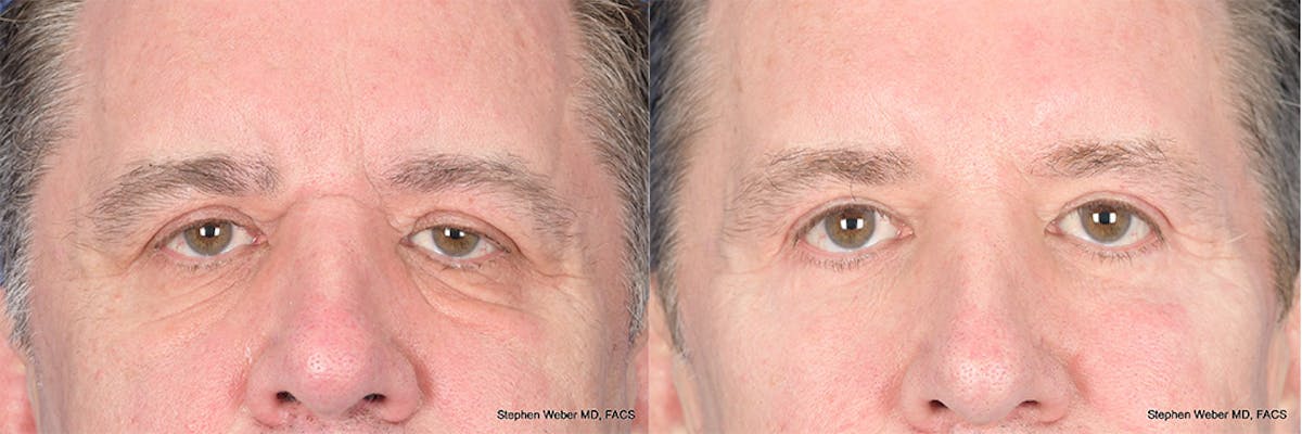 Dermal Filler Before & After Gallery - Patient 254202 - Image 1