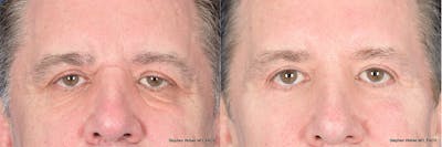 Dermal Filler Before & After Gallery - Patient 254202 - Image 1