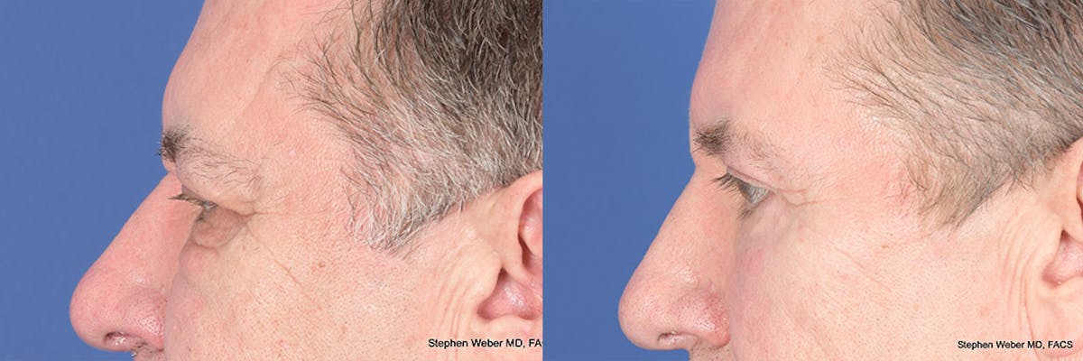Dermal Filler Before & After Gallery - Patient 254202 - Image 2