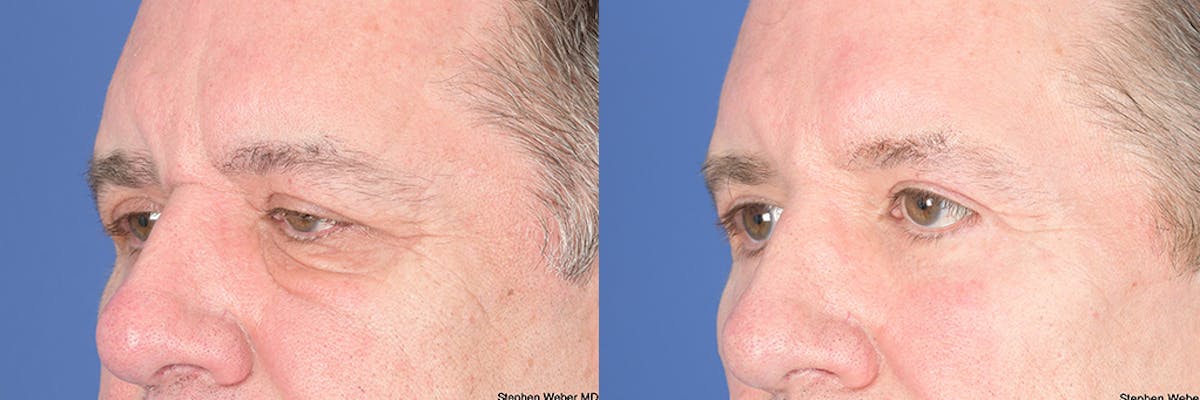 Dermal Filler Before & After Gallery - Patient 254202 - Image 3