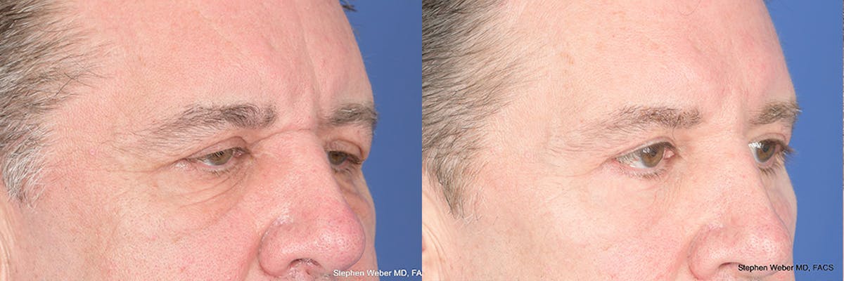 Dermal Filler Before & After Gallery - Patient 254202 - Image 4