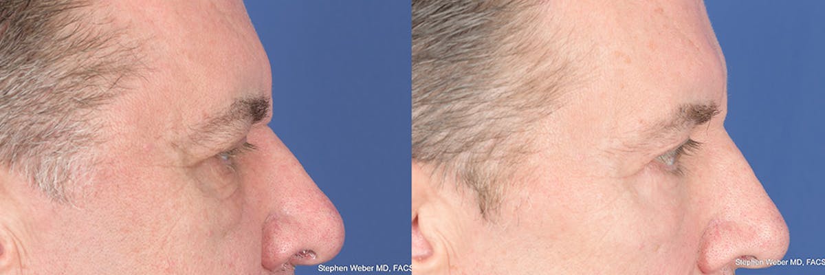 Dermal Filler Before & After Gallery - Patient 254202 - Image 5