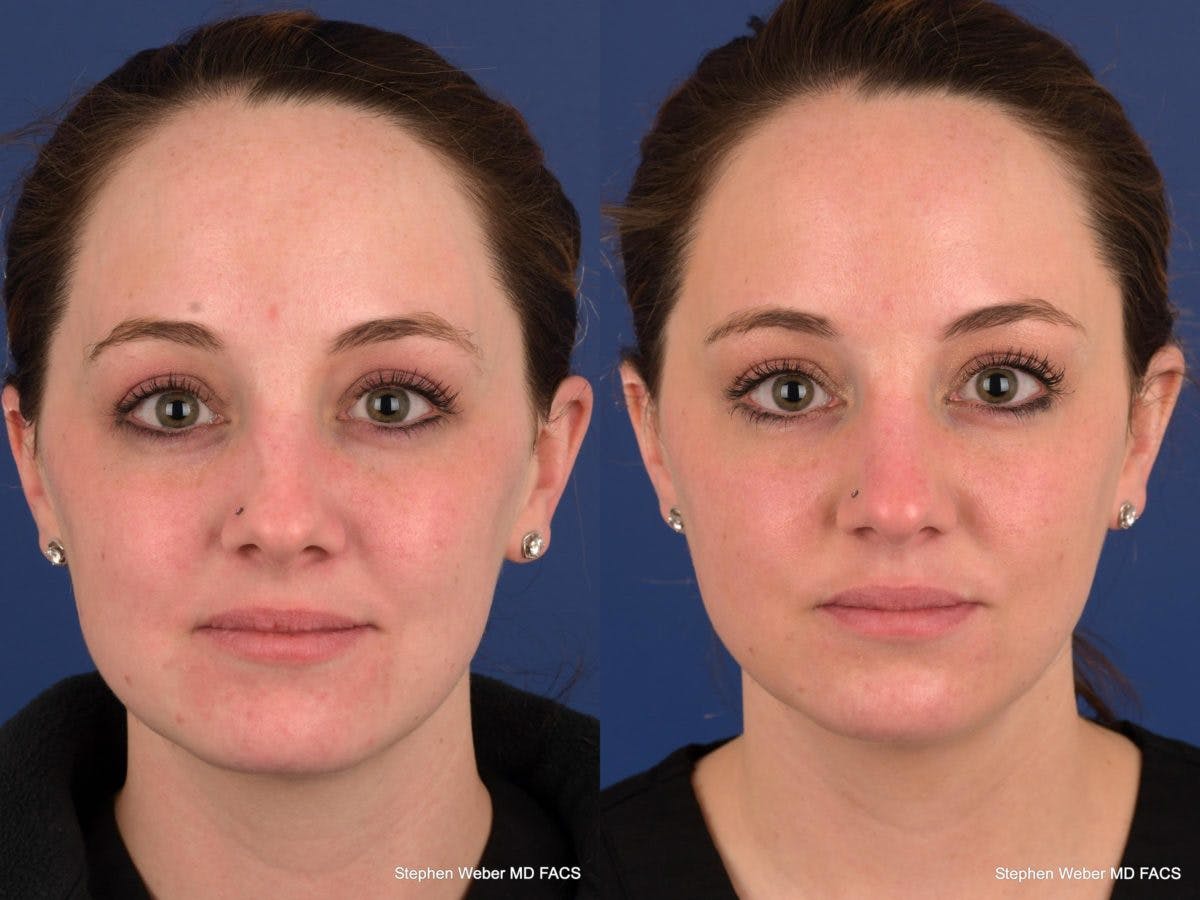 Dermal Filler Before & After Gallery - Patient 634995 - Image 1