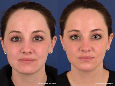Dermal Filler Before & After Gallery - Patient 634995 - Image 1