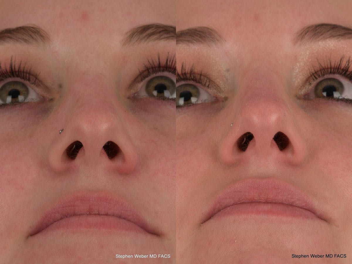 Dermal Filler Before & After Gallery - Patient 634995 - Image 2