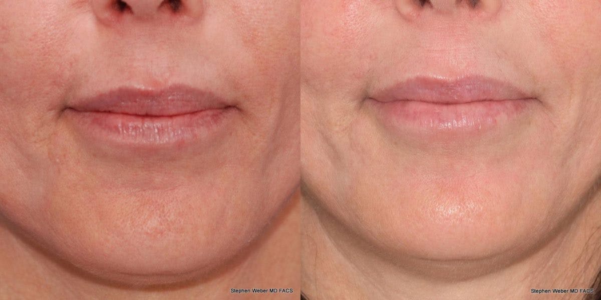 Dermal Filler Before & After Gallery - Patient 121576 - Image 1