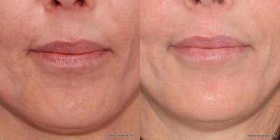 Dermal Filler Before & After Gallery - Patient 121576 - Image 1