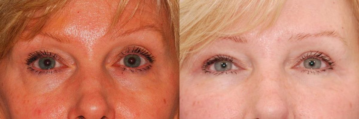 Dermal Filler Before & After Gallery - Patient 115323 - Image 1