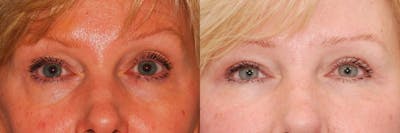 Dermal Filler Before & After Gallery - Patient 115323 - Image 1