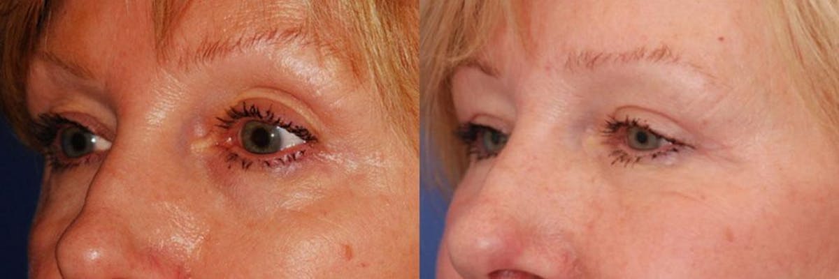 Dermal Filler Before & After Gallery - Patient 115323 - Image 2