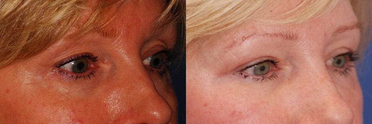 Dermal Filler Before & After Gallery - Patient 115323 - Image 3