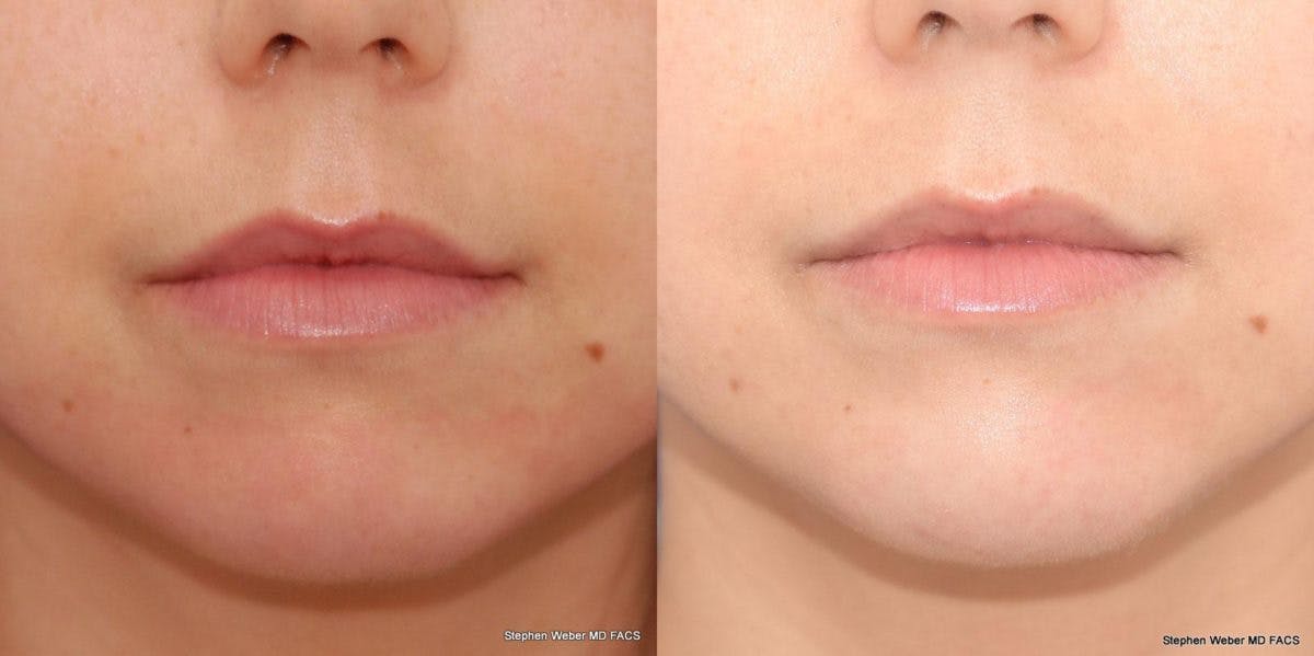 Dermal Filler Before & After Gallery - Patient 208685 - Image 1