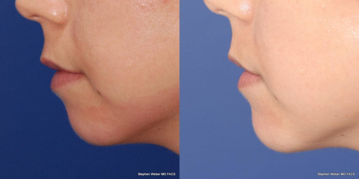 Dermal Filler Before & After Gallery - Patient 208685 - Image 2