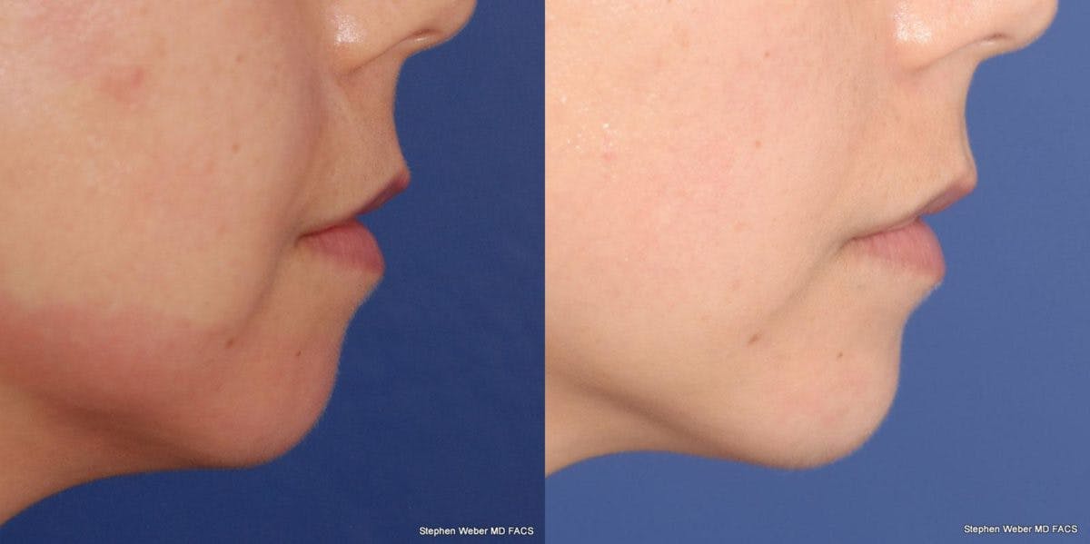 Dermal Filler Before & After Gallery - Patient 208685 - Image 3