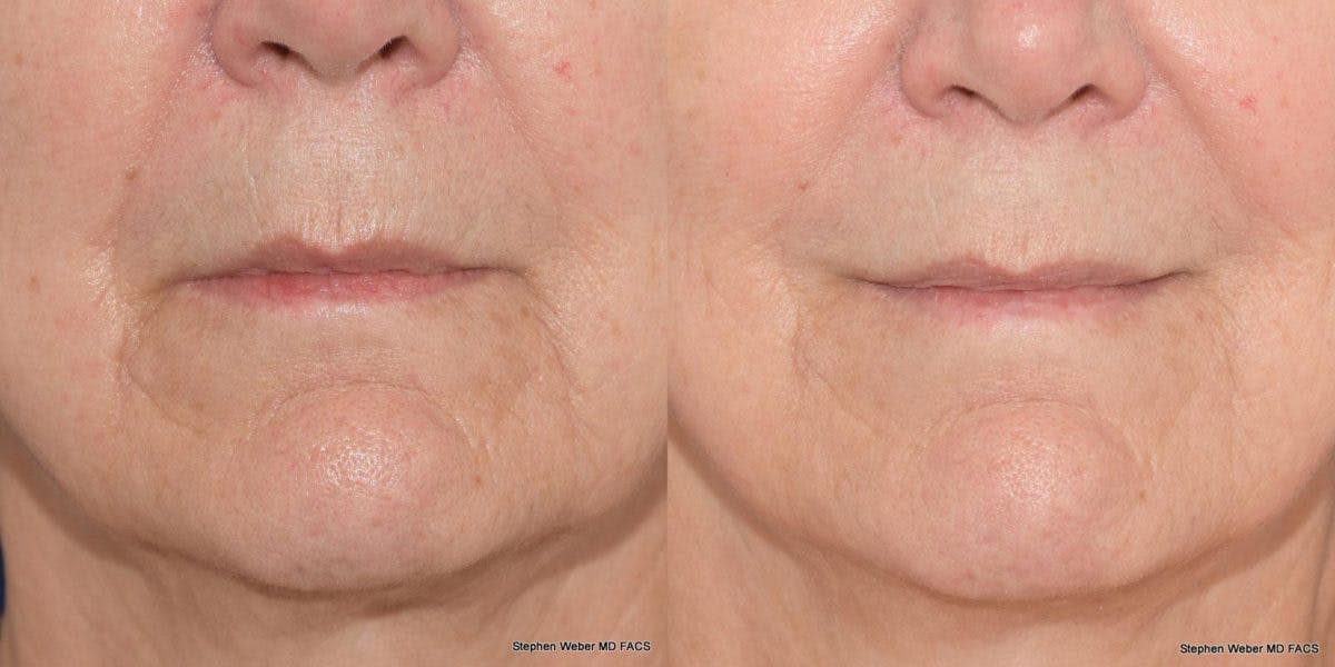 Dermal Filler Before & After Gallery - Patient 231476 - Image 1