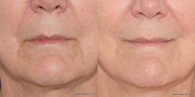 Dermal Filler Before & After Gallery - Patient 231476 - Image 1