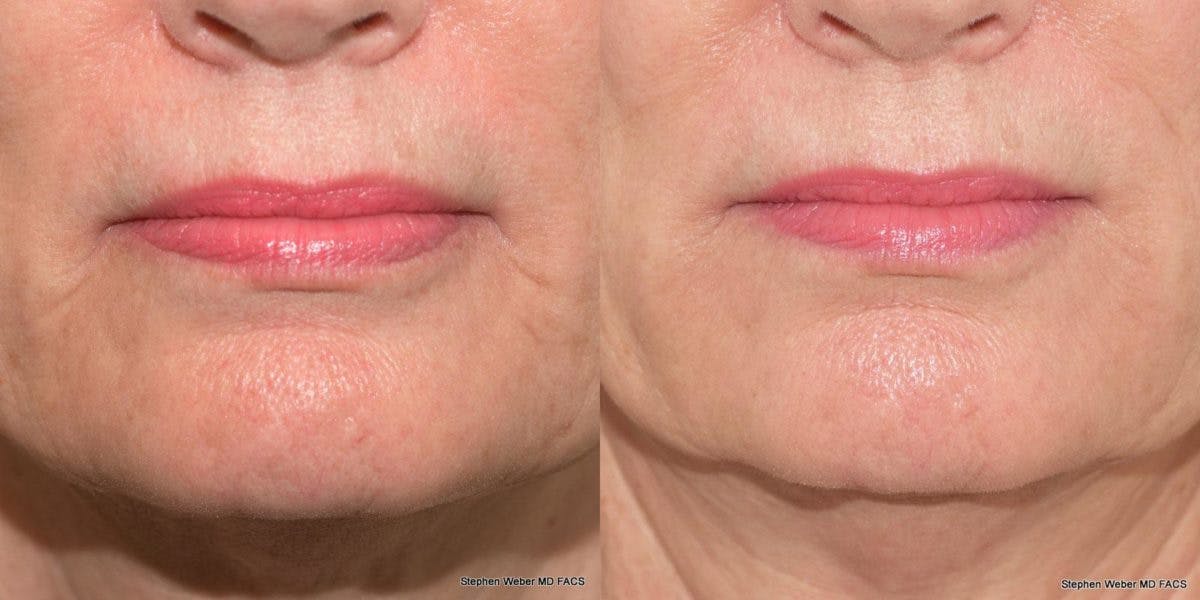 Dermal Filler Before & After Gallery - Patient 116327 - Image 1