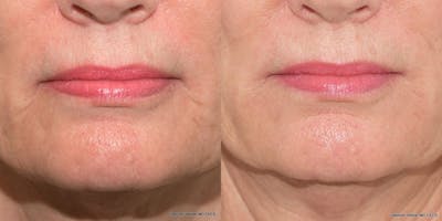 Dermal Filler Before & After Gallery - Patient 116327 - Image 1