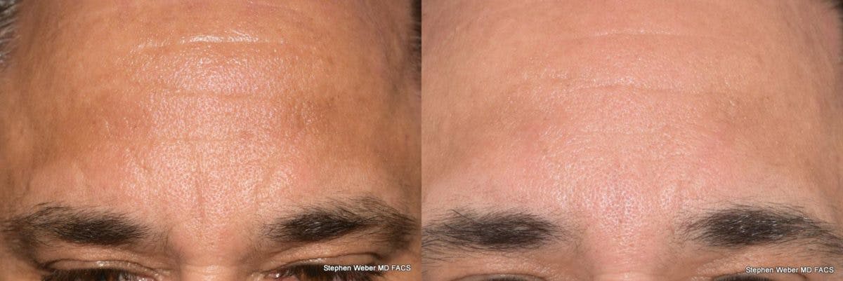 Dermal Filler Before & After Gallery - Patient 150614 - Image 1