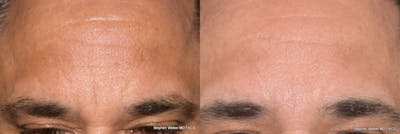 Dermal Filler Before & After Gallery - Patient 150614 - Image 1