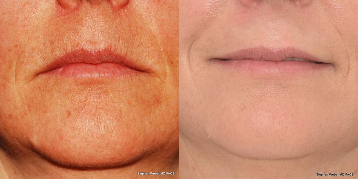 Dermal Filler Before & After Gallery - Patient 113186 - Image 1