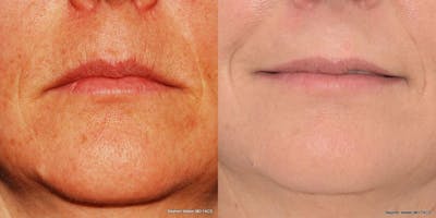 Dermal Filler Before & After Gallery - Patient 113186 - Image 1