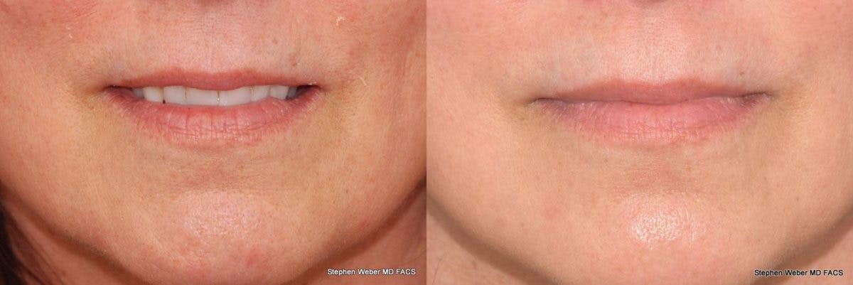 Dermal Filler Before & After Gallery - Patient 342199 - Image 1