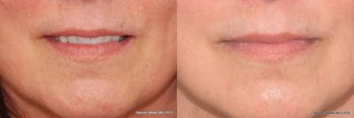 Dermal Filler Before & After Gallery - Patient 342199 - Image 1