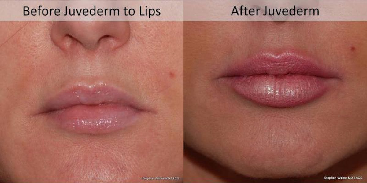 Dermal Filler Before & After Gallery - Patient 265819 - Image 1